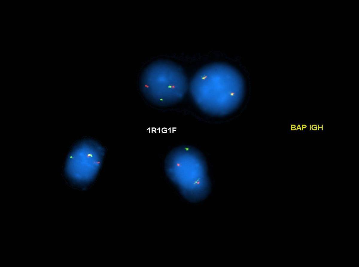 EV1-IGH rearrangement by FISH